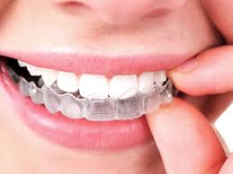 Invisalign for the Perfect Smile